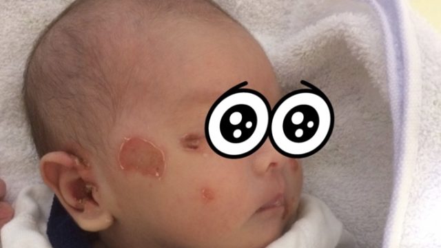 生まれて数日、乳児湿疹がこじれて大変なことに