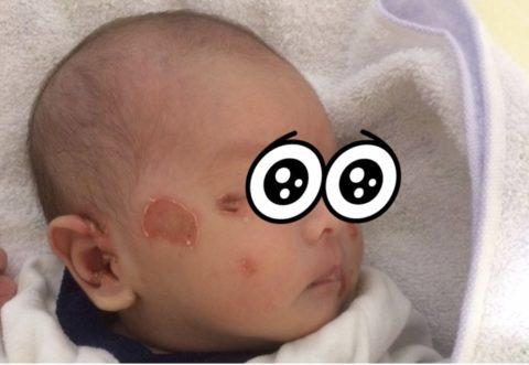 生まれて数日、乳児湿疹がこじれて大変なことに